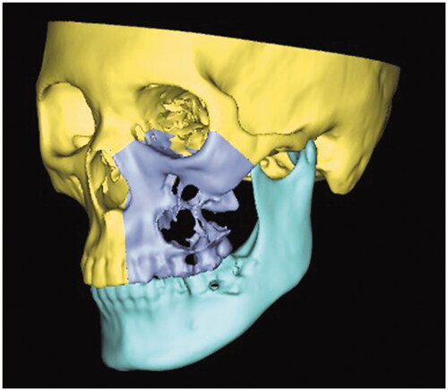 Figure 1. Virtual surgical planning of total maxillectomy.