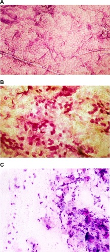 Figure 2 Cytologic aspects in CSSS.