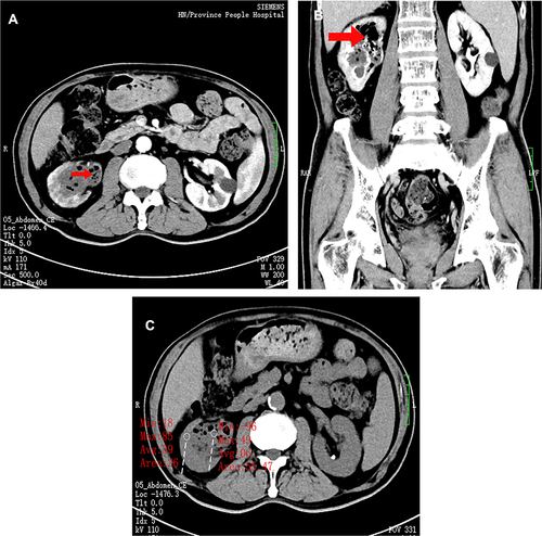 Figure 1 (A) In the bilateral kidneys in the contrast-enhanced CT window, the side marked with red represents the right renal pelvis, and the pneumopelvic shadow in the renal pelvan be seen at the red arrow, while the dilatation of the left renal pelvis is not obvious on the right side, and there is no obvious gas accumulation. (B) In contrast-enhanced CT windows in different slices, right pneumopelvic shadow is seen at the red arrow, and plenty of air and infected shadows are seen in the renal pelvis. (C) In the unenhanced CT window, the CT value of the right renal pelvis can be seen at the two red marks compared with the CT value of the infection in the renal pelvis.