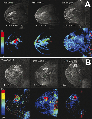 Figure 1. DCE-MRI images (first row) of one sagittal image through the centre of the tumour for a patient that responded (A) and did not respond to treatment (B), respectively, pre cycle I, pre cycle II and before surgery. On each image, the size of the lesion based on MR is given. The wash-in parametric maps are shown in the second row. The scales refer to wash-in parameter values, no units.