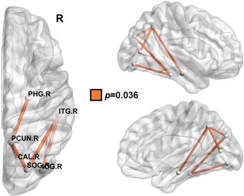 Figure 4 Compared with healthy controls, patients with PNES showed a reduced connectivity network in the right posterior areas, detected by NBS and the AAL atlas parcellation scheme. The node abbreviations correspond to those of Supplementary Table 1.