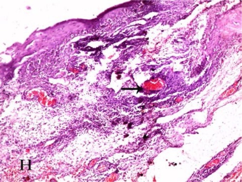 Figure 4 A photomicrograph of untreated pterygium section showing connective tissue stroma that is covered by conjunctival epithelium.