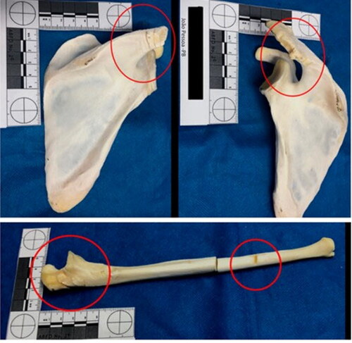 Figure 6. Several false starts with eversion of the bone margins on both scapulas and the proximal epiphysis of the left ulna (see the red circles).