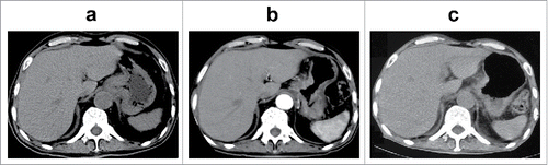 Figure 3. Imaging characteristics of the patient during apatinib treatment. Abdominal CT scans were shown before (a), 2 months (b) and 7 months (c) after initiation of apatinib therapy, demonstrating gradual shrinkage of tumor lesions.