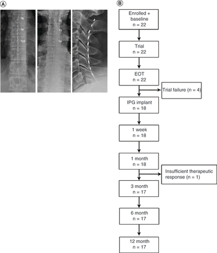 Figure 1. Study flow. (A) Octopolar leads were placed based on the location of pain. Lead placements for subjects with lower limb pain are shown on the left, for pain of the trunk in the center and for upper limb pain on the right. (B) Flow chart showing subject progression through the study.EOT: End of trial; IPG: Implantable pulse generator.