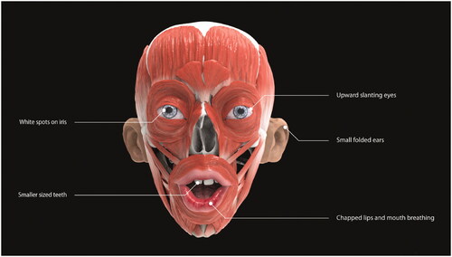 Figure 10. Reba (Rebekah) Sadok – Down Syndrome facial muscles 3D model.