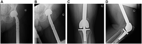 Figure 2 Post- operative X-ray from case report Patient 7 who underwent wide resection and total femur replacement. (A) AP hip, (B) lateral hip, (C) Ap knee, (D) lateral knee.