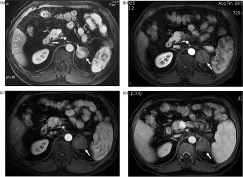Figure 3. MW ablation in a 51-year-old man who had a left adrenal metastasis from hepatocellular carcinoma. (a) Before treatment the tumour was enhanced on contrast-enhanced MRI. No enhancement was observed on contrast-enhanced MRI at three months (b), six months (c) and one year (d) after MW ablation.