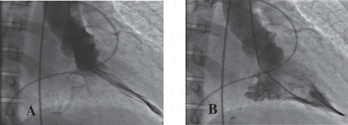 Figure 3. Cardiac catheterization of 46-year-old woman with apical hypertrophic cardiomyopathy during systole (a) and diastole (b). Findings were consistent with a spade shaped / Japanese variety / apical hypertrophic cardiomyopathy.