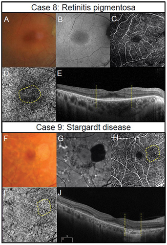 Figure 5. Multimodal imaging in inherited retinal dystrophies. Retinitis pigmentosa in a 40-year-old female (Case 8). (A) Fundus photography of the central retina. Outside this region, attenuated arterioles are present indicative of advanced stage of the disease process. The patient also has midperipheral spicule-like pigmentation not visible in the photograph. (B) Hyper-auto fluorescent ring around the macula (fundus autofluorescence imaging). (C) Subtle reduction in peripheral perfusion with 6 × 6 mm OCT-A superficial capillary slab (set from inner limiting membrane to posterior inner plexiform layer). (D) Impaired flow in the regions of outer retinal atrophy (outside the dashed yellow lines) with 6 × 6 mm OCT-A set at the level of the choriocapillaris (defined as 29 and 49 microns beneath the RPE). (E) Borders of preserved outer retina (yellow dashed lines) on structural OCT corresponding to borders of normal choriocapillaris flow on OCT-A corresponding to edge of remaining photoreceptors and the edge of the hyperfluorescent region in Figure 5B. The thinner retina outside the region identified by the yellow dashed line allows the deeper choroidal layers to be identified. (Case 9) Stargardt disease in a 62-year-old female. (F) Fleck-like fundus lesions with a region of outer retinal atrophy nasal to inferior to the fovea in the left eye. (G) Hypo-autofluorescence corresponding to the area of atrophy due to the loss of retinal pigment epithelial cells and the fleck-like lesions (hyper-auto fluorescent) are also more evident. (H) Subtle reduction in perfusion (yellow dashed region) in the area of atrophy detected using 6 × 6 mm OCT-A superficial capillary slab (set from inner limiting membrane to posterior inner plexiform layer). (I) 6 × 6 mm OCT-A choriocapillaris slab shows increased visibility of the choriocapillaris flow signal (yellow dashed region) corresponding to the area of atrophy. (J) Borders of atrophy delineated using structural OCT correspond to the region of flow impairment (yellow dashed lines). There is increased choroidal reflectance in the area of atrophy with a loss of photoreceptors and retinal pigment epithelium.