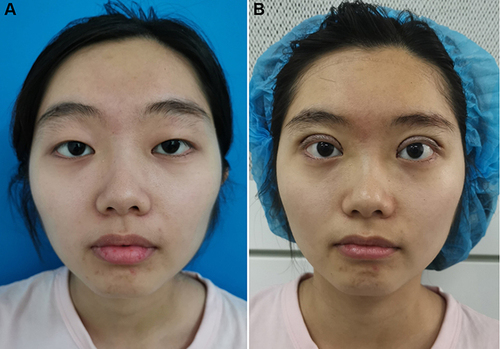 Figure 9 (A) Photograph of the patient who looked exhausted before surgery. (B) Immediately after surgery, her MRD1 had significantly increased, her forehead was larger, eyebrows were lower, and facial proportions became more harmonious. She looked more attractive and alert after the operation.