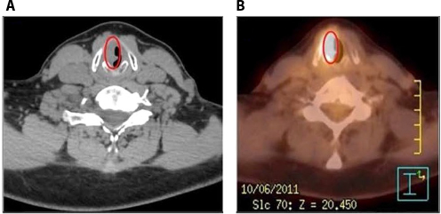 Figure 1 Whole-body fluorodeoxyglucose (FDG)-positron emission tomography (PET)/computed tomography (CT) images showing focal tracer’s uptake (maximum standard uptake value 10,47) located in the right true and false vocal cord. (A) CT image, (B) PET/CT image. The red oval in imaging indicates the lesion.
