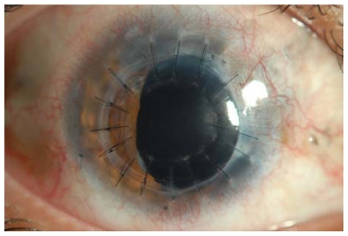 Figure 4 Photograph of anterior segment of the right eye 2 months after keratoplasty.