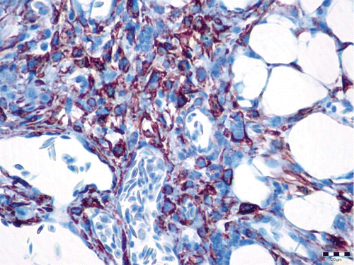 Figure 4. α-SMA cytoplasmic positivity (brown) in benign neoplastic smooth muscle cells of the angiolipoleiomyoma. Immunohistochemistry, diamino-benzidine–chromogen. Bar: 20 µm.