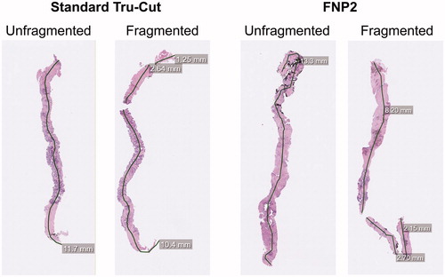 Figure 4. Representative images of biopsies taken by standard Tru-cut and FNP2 needles, with and without fragmentation. Black lines show the digital measurement path and grey boxes are annotations indicating the measured length of each fragment.