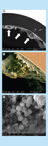 Figure 15.  Evidence of catheter-associated biofilm growth in vivo. (A) Original magnification ×200 demonstrating the irregular undulating pattern of the biofilm surface. (B) Higher magnification of a tower from the image shown in (A) revealing a predominantly hollow interior with numerous cocci at the margins (original magnification ×800). The image has been pseudocolored to highlight Staphylococcus aureus (gold) and presumably matrix material (green), which likely aggregated during the SEM dehydration process, from remaining biofilm structure (gray). The smooth surface at the upper right represents the catheter (salmon) with biofilm visible on the internal face. (C) Original magnification ×3000 of an Staphylococcus aureus cluster within the tower depicted in (B).SEM:Scanning electron microscopy.Reproduced with permission from [Citation7] © The American Association of Immunologists, Inc. (2011).