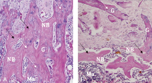 Figure 3. Bisphosphonate-treated specimen to the left (A) and saline-treated control to the right (B) (hematoxylin and eosin, ×40). A. Note how the new-formed bone (NB), identifiable by the existing cell nuclei (black arrows), covers the old graft bone (G) with its lost nuclei (white arrows). Due to the delayed resorption, an old bone–new bone construct is formed. B. In the saline-treated control, such a construct does not form as extensively. The graft bone (G) is resorbed and replaced by new bone (NB), which is in turn immediately resorbed, being replaced by a hematogenous/fat cell marrow (Ma).