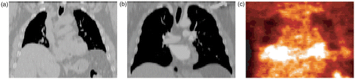 Figure 1. CT images (coronal views) corresponding to two different instants in the breathing cycle, end-expiration (a) and end-inspiration (b), and a PET image (c) of the same patient (patient A in our tests). [Color version available online.]