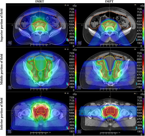 Figure 1. Axial dose-color-wash comparing IMRT and IMPT plans. Representative dose-color-wash images in axial planes comparing intensity-modulated photon radiation therapy (IMRT) (left) and intensity-modulated proton therapy IMPT (right) plans, with the dose increasing as the color ranges from blue to green to red. Axial images are divided into superior (top), middle (middle), and inferior (bottom) portions of the target. As shown, low to intermediate doses to surrounding organs at risk were higher with IMRT plans.