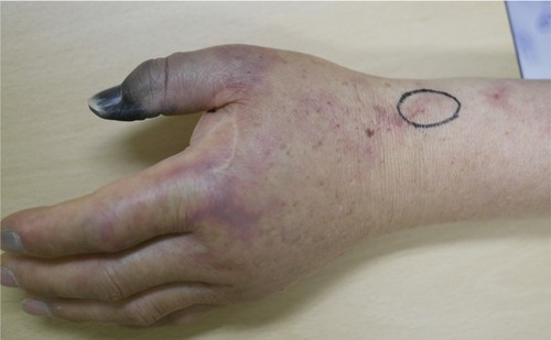 Figure 1 At the time of admission, necrosis of the left distal thumb phalanx was observed and an injection mark (black circle) was visible in the proximal portion of the radial styloid process.
