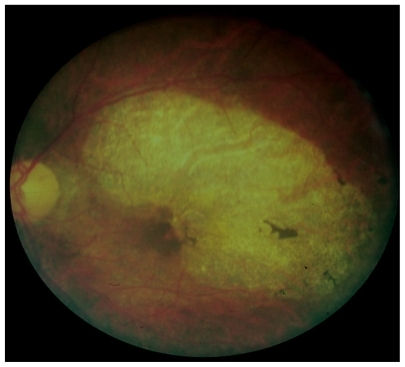 Figure 4 Typical optic atrophy and chorioretinal and pigment epithelial disease in a subject infested with Onchocerca volvulus.