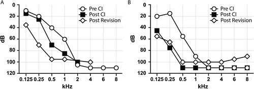 Figure 1 Unaided hearing thresholds tested for patient 1 (A) and patient 2 (B) before cochlear implantation (white circles), after cochlear implantation (black squares), and after revision surgery (white rectangles).