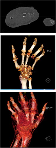 Figure 2. CT Scan with bone and vascular reconstruction.