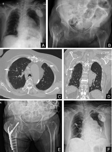 Figure 1. Radiographic images of the chest and the hip. Plain radiographs (Panels A and B) obtained at our emergency department show prominently increased interstitial opacities at the peripheral area in both lungs (A) and right femur intertrochanteric fracture (B). Axial and coronal CT images (Panels C and D) show nodular opacities based in the subpleural area (arrows) and a small amount of bilateral pleural effusion. Panels E and F are plain radiographs taken the day after surgery.