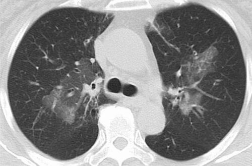 Figure 1 Chest computed tomography (CT) with the lung window setting shows ground-glass shadows and infiltrations in bilateral central lung fields.
