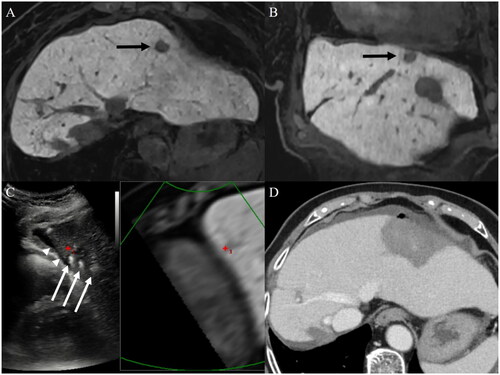 Figure 2. Percutaneous ablation for a subcardiac hepatocellular carcinoma (HCC) with artificial ascites under fusion image guidance. Gadoxetic acid-enhanced axial (A) and coronal (B) hepatobiliary phase MR images displays a 2.0-cm low signal intensity HCC (arrows) abutting the heart in the left lateral section of the liver. (C) Under fusion imaging guidance, three applicators (arrows) are inserted around the target tumor (red cross marker located at the upper margin of the low echoic target tumor). Artificial ascites (arrowheads) in the perihepatic space not only prevents thermal injury to adjacent organs but also helps insert applicators accurately around the target tumor without puncturing the pericardium. (D) Immediate follow-up contrast-enhanced portal venous phase axial CT demonstrates complete destruction of the target lesion with sufficient ablation margin.