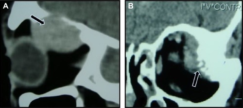 Figure 2 Computed tomography scans with contrast showing bone changes in orbital metastasis.