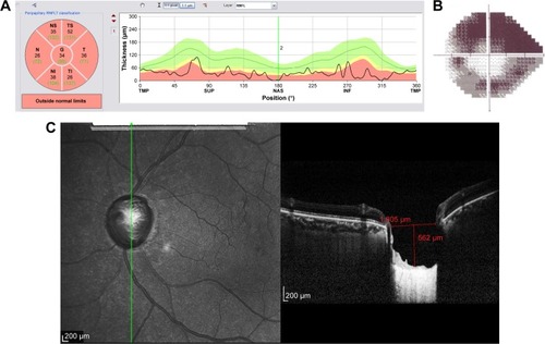 Figure 12 Structural and functional findings in a glaucomatous eye in percentile group 4 of the HVOC (mean =1,662 µm, mean MD =−12.90 (1.4) dB). (A) Circumpapillary RNFLT; (B) standard automated perimetry grayscale map; (C) B-scan of the largest vertical optic disc cup and length and depth used to calculate the HVOC.