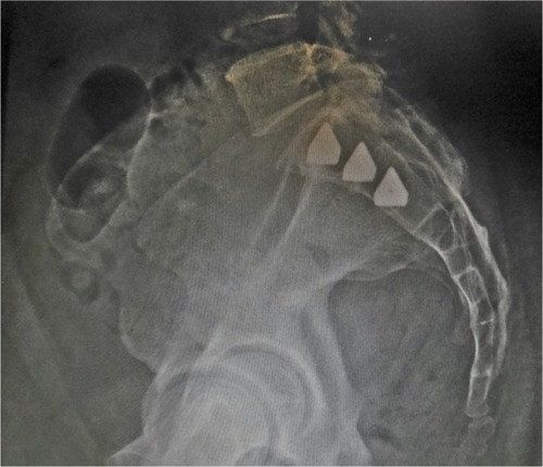Figure 3 Lateral view of three implants in position.