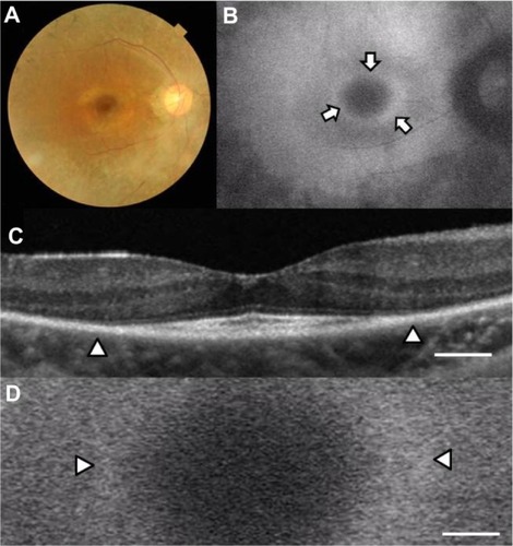 Figure 1 Fundus images of the right eye in case 1. Color fundus photograph (A), short-wave length fundus autofluorescence photograph (B), spectral-domain optical coherence tomographic image (C), and magnifed fundus autofluorescence photograph of the macula (D). Arrows show a parafoveal high-density fundus autofluorescence ring (B). Arrowheads show the border of the external limiting membrane and the inner segment and outer segment line (C) and parafoveal high-density fundus autofluorescence ring (D). Bar = 200 μm (C and D).