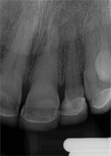 Figure 19. Case 1 2nd pre-op radiograph.