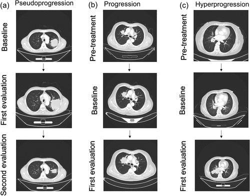 Figure 2. CECT scans: (a) Pseudoprogression, (b) Progression, and (c) Hyperprogression. Baseline CECT was performed when the patient was receiving immunotherapy, pre-treatment CT was performed more than 2 weeks before immunotherapy, and the first and second evaluations were within 6 months.