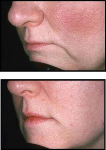 Figure 4 A clinical example of the use of Restylane® for nasolabial folds.