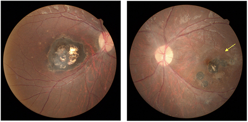 Figure 1 Color fundus photographs of the first case. (Left) Fundus photograph of the right eye indicated a wagon-wheel retinochoroidal scar in the macula, with no active lesions. (Right) Fundus photograph of the left eye showed multiple retinochoroidal scars in the parafoveal area, with retinal exudates and vascular sheathing noted at the temporal margin of the previous scar (yellow arrow).