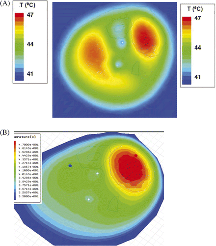 Figure 11. Simulated temperature distributions for a hyperthermia treatment of the human sarcoma shown in Figure 10. A) Predicted temperature distribution for the leg at approximately 18 minutes into treatment using equal phase and amplitude excitation, heat is focused in the low perfusion tumour region but also heats normal tissue on the left side of the leg; B) temperature distribution for the leg predicted for 25 min into treatment after adjusting antenna phase to the simulated optimal values, heat is focused primarily in the tumour region in the upper right of the leg.