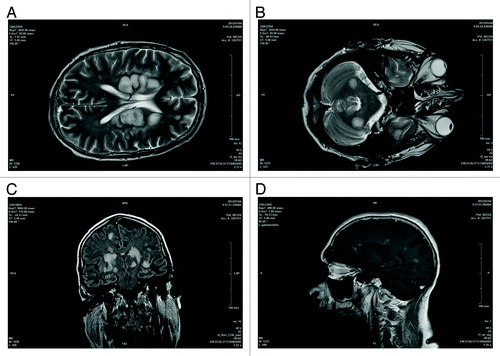 Figure 1. Axial T2 encephalic magnetic resonance (A and B), coronal FLAIR (C), and sagittal T1 post Gd (D) sequences demonstrated: multiple white matter focal lesions located in cerebral and cerebellar hemispheres, predominantly symmetric and cortico-medullary. These lesions are hyperintense on FLAIR, DWI sequences (some of them with increased ADC) with contrast enhancement of larger lesions.