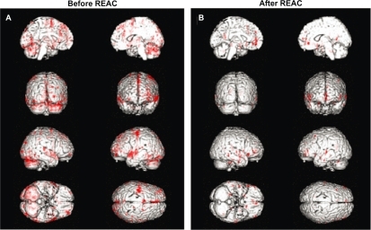 Figure 5 Functional magnetic resonance images in healthy subjects asked to perform finger tapping. (A) Before REAC-NPO treatment and (B) after REAC-NPO treatment.