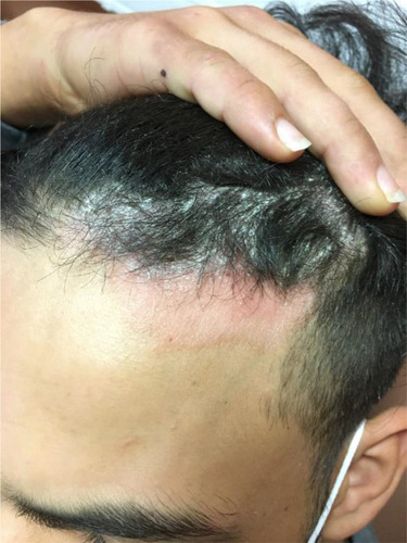 Figure 2 Scalp psoriasis in a 16-year-old boy. This adolescent was suspected of having tinea capitis.