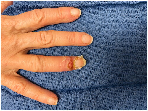Figure 2. POD 7 following fenestration of bullae and evolution of superficial wounds.