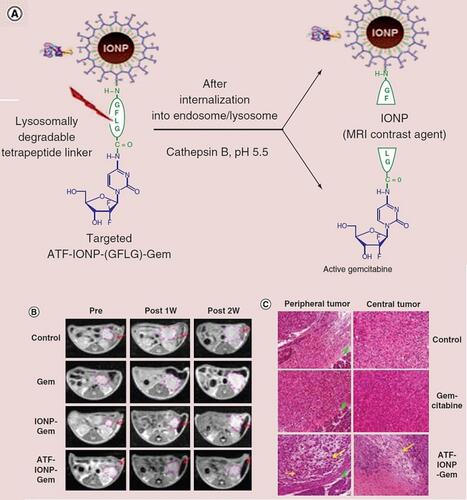 Figure 5 Magnetic resonance imaging of iron oxide nanoparticles based chemotherapy. (A) Scheme of development of gemcitabine conjugated iron oxide nanoparticles. (B) MRI observation of the therapeutic response of controlled released gemcitabine. (C) Histologic staining endorses the targeted therapeutic of pancreatic tumor. Adapted with permission from Lee GY, Qian WP, Wang L, et al. Theranostic nanoparticles with controlled release of gemcitabine for targeted therapy and MRI of pancreatic cancer. ACS Nano. 2013;7(3):2078–2089. Copyright © 2013, American Chemical Society.Citation147