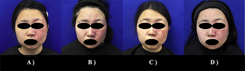 Figure 1 Various stages of treatment for Case 1. (A) Baseline; (B) 6M: Before the second treatment; (C) 12M: Before the third treatment; (D) 14M: Treatment endpoint.