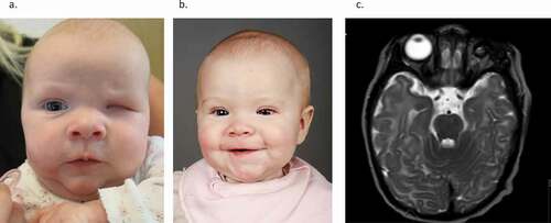 Figure 2. (a–c) Child born with small microphthalmic left eye. (a) Two months of age. (b) Treated with expanding conformers-at eight months of age she is wearing a-left eye prosthesis. Right eye normal. (c) Magnetic resonance tomography (T-2 weighted) of the brain and orbits. Note the microphthalmic left eye. (Published with permission from the parents).