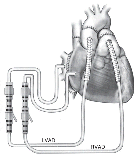 Figure 3 Bicaval implant technique. For RVAD support, the body of the right atrium is cannulated away from the superior and inferior vena caval anastomoses. Outflow from the RV AD is to a graft cannula sewn to the main pulmonary artery (PA). The graft is placed just distal to the pulmonary valve but proximal to the anastomosis between the donor and recipient PA. For LVAD support, the recipient left atrial cuff is cannulated adjacent to the right pulmonary vein, providing drainage to the pump. Outflow from the LVAD is to a graft cannula sewn to the recipient aorta just above the aortic valve (J Thorac Cardiovasc Surg 2003; 126:442-447; Fig. 1).