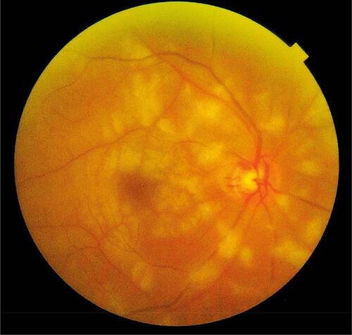 Figure 1 Right eye fundus photograph shows large cotton-wool spots in a peripapillary distribution as well as a heterogeneous pattern of grey translucency with periarterial sparing in the macula.
