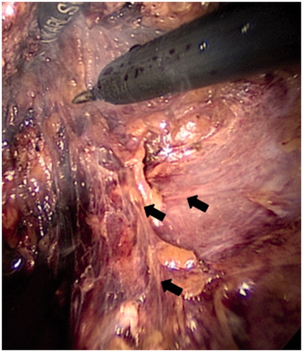 Figure 2. Visually assessed tiny nerve fibers heading to the internal anal sphincter (arrows)