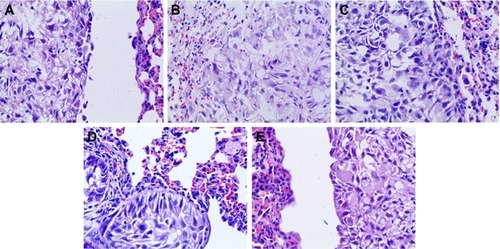 Figure 11 Pathomorphological changes of A549 tumor section in all the groups (×400).Notes: (A) Positive group, (B) combination group, (C) test group, (D) reference group, and (E) model group.